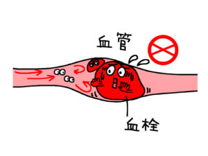 高靈敏度血栓檢測D-dimer